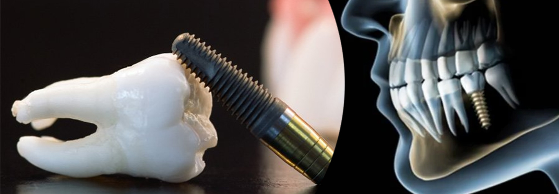 Dental Implants in Wakad