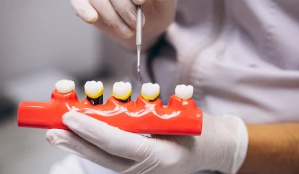 Dental Implants Procedure