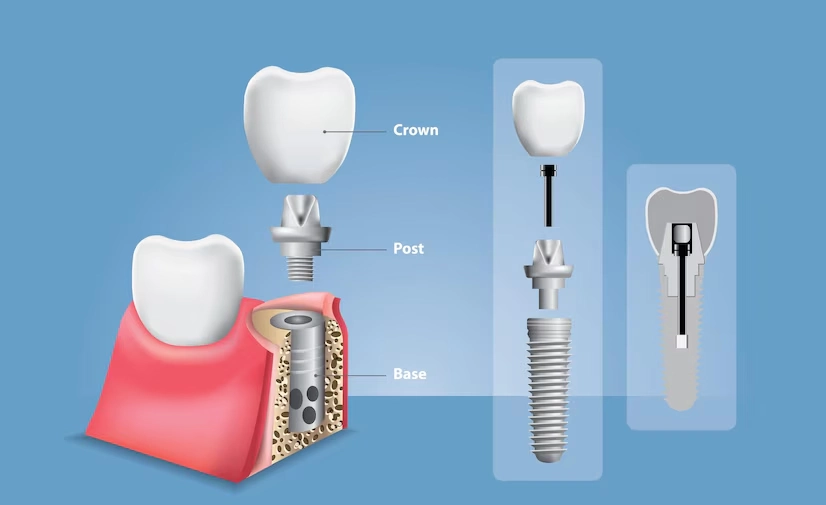 what is dental implant failure?